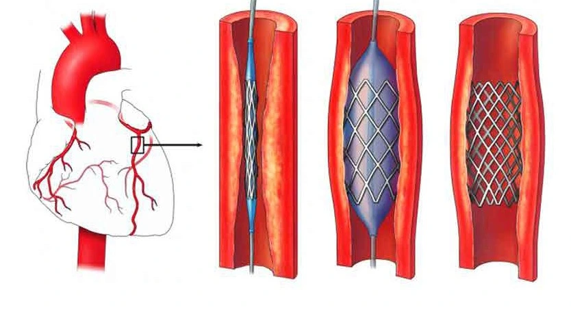 Cardiac catheterization lab at Trusted Multispeciality Hospital in Dhayari – Silver Birch Hospital